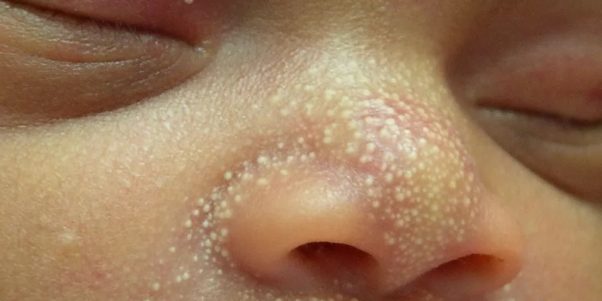 &laquo;Поцелуйная болезнь&raquo;: скрытая опасность для младенцев, о которой должны знать все родители