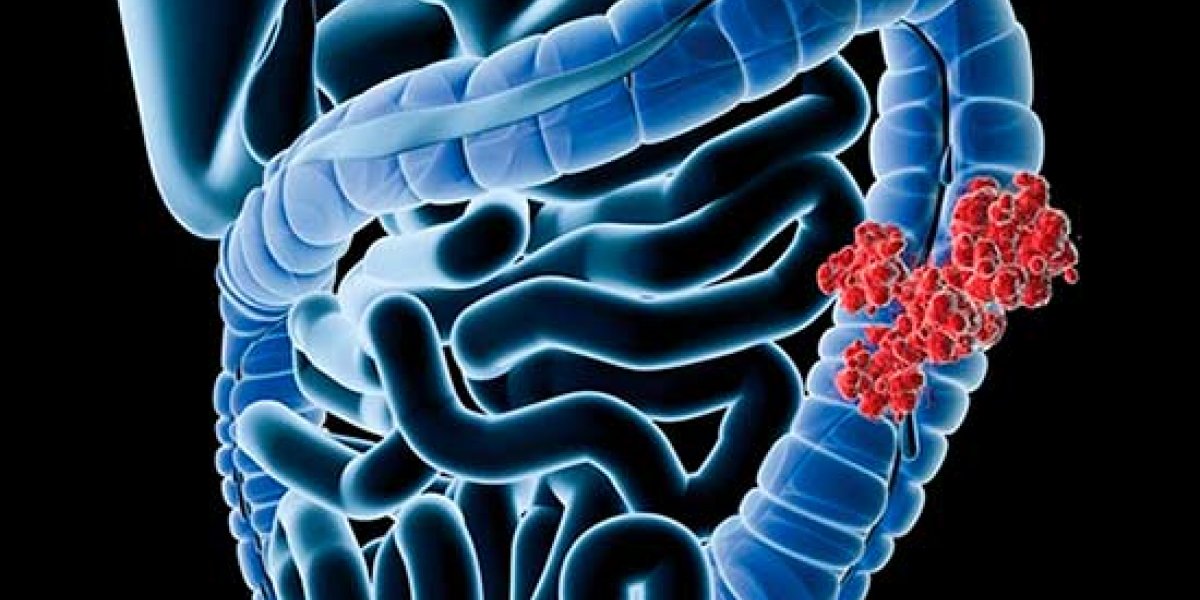 Невидимые сигналы: как микробиом кишечника предупреждает о раке до появления симптомов