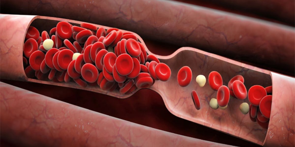 Тихий убийца: как тромб маскируется под обычную усталость Тихий убийца: как тромб маскируется под обычную усталость